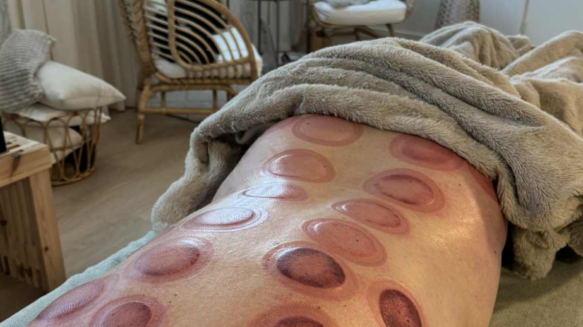 Cupping behandling